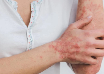 Síntomas, tratamientos y consejos para no contagiarse la viruela del mono, un virus que preocupa a la OMS